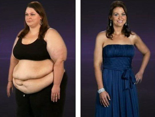 Before and after image of obese woman